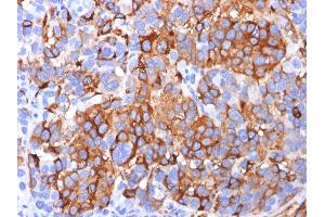 Formalin-fixed, paraffin-embedded human Melanoma stained with MART-1 / Melan-A Mouse Monoclonal Antibody (A103). (MLANA anticorps)