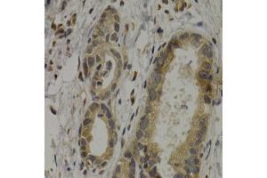 Immunohistochemistry of paraffin-embedded human stomach cancer using MAGEA1 antibody (ABIN5973183) at dilution of 1/200 (40x lens). (MAGEA1 anticorps)