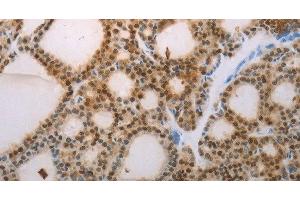 Immunohistochemistry of paraffin-embedded Human thyroid cancer tissue using S100A1 Polyclonal Antibody at dilution 1:70