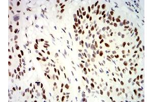 Immunohistochemical analysis of paraffin-embedded esophageal cancer tissues using UHRF1 mouse mAb with DAB staining. (UHRF1 anticorps  (AA 616-755))