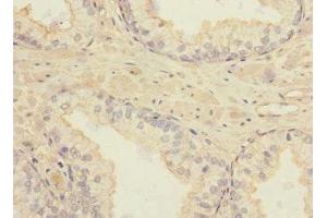 Immunohistochemistry of paraffin-embedded human prostate cancer using ABIN7171878 at dilution of 1:100 (TSPAN4 anticorps  (AA 107-201))