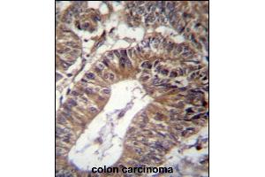 GCC1 Antibody (C-term) (ABIN656908 and ABIN2846105) immunohistochemistry analysis in formalin fixed and paraffin embedded human colon carcinoma followed by peroxidase conjugation of the secondary antibody and DAB staining. (GCC1 anticorps  (C-Term))