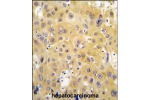 Formalin-fixed and paraffin-embedded human hepatocarcinoma tissue reacted with ECGF1 antibody , which was peroxidase-conjugated to the secondary antibody, followed by DAB staining. (Thymidine Phosphorylase anticorps  (AA 318-345))