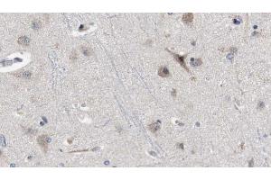 ABIN6272329 at 1/100 staining Human brain cancer tissue by IHC-P. (IL1RAPL2 anticorps  (Internal Region))