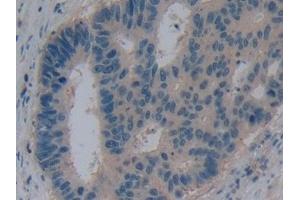 Detection of AQP1 in Human Colorectal cancer Tissue using Polyclonal Antibody to Aquaporin 1 (AQP1)