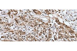 Immunohistochemistry of paraffin-embedded Human gastric cancer tissue using UPK3A Polyclonal Antibody at dilution of 1:30(x200) (Uroplakin 3A anticorps)