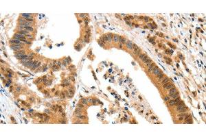 Immunohistochemistry of paraffin-embedded Human colon cancer tissue using HTR3A Polyclonal Antibody at dilution 1:50 (Serotonin Receptor 3A anticorps)
