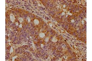 IHC image of ABIN7169092 diluted at 1:300 and staining in paraffin-embedded human pancreatic cancer performed on a Leica BondTM system. (NEK1 anticorps  (AA 1-104))