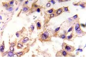 Immunohistochemistry (IHC) analyzes of p-eIF4E in paraffin-embedded human breast carcinoma tissue. (EIF4E anticorps  (pSer209))