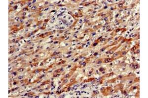 Immunohistochemistry of paraffin-embedded human liver cancer using ABIN7161673 at dilution of 1:100 (Olfactomedin 1 anticorps  (AA 374-441))