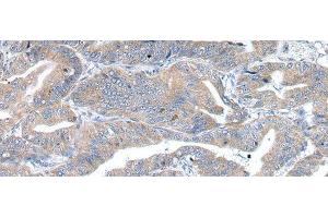 Immunohistochemistry of paraffin-embedded Human esophagus cancer using RAB2A Polyclonal Antibody at dilution of 1/40
