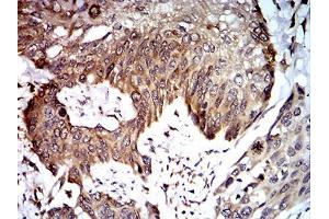 Immunohistochemical analysis of paraffin-embedded esophageal cancer tissues using UFD1L mouse mAb with DAB staining.