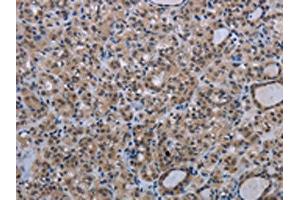 The image on the left is immunohistochemistry of paraffin-embedded Human thyroid cancer tissue using ABIN7191353(MAGEC1 Antibody) at dilution 1/30, on the right is treated with synthetic peptide. (MAGEC1 anticorps)