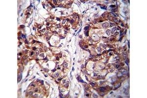 DDR1 antibody immunohistochemistry analysis in formalin fixed and paraffin embedded human breast carcinoma.