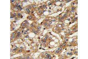 IHC analysis of FFPE human hepatocarcinoma with IFNB1 antibody