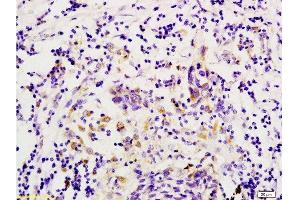 Formalin-fixed and paraffin embedded human colon carcinoma labeled with Anti-GPR49/LGR5 Polyclonal Antibody, Unconjugated  at 1:200 followed by conjugation to the secondary antibody and DAB staining.