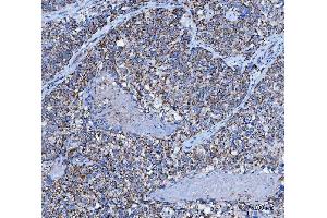 IHC analysis of TRK fused gene/TFG using anti-TRK fused gene/TFG antibody (ABIN7599839). (TFG anticorps  (AA 121-400))