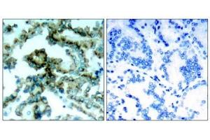 Immunohistochemical analysis of paraffin-embedded human lung carcinoma tissue, using PKCβ (phospho-Thr641) antibody (E011172). (PKC beta anticorps  (pThr641))