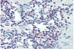 Human Colon, Lymphocytes (formalin-fixed, paraffin-embedded) stained with PLCG1 antibody ABIN337039 at 1:25-1:100 followed by biotinylated goat anti-rabbit IgG secondary antibody ABIN481713, alkaline phosphatase-streptavidin and chromogen. (Phospholipase C gamma 1 anticorps  (C-Term))