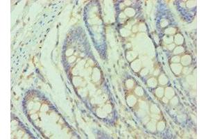 Immunohistochemistry of paraffin-embedded human colon tissue using ABIN7155523 at dilution of 1:100 (SMYD3 anticorps  (AA 199-428))