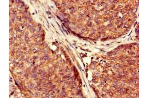 Immunohistochemistry of paraffin-embedded human ovarian cancer using ABIN7174352 at dilution of 1:100 (USP6 anticorps  (C-Term))