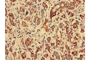 Immunohistochemistry analysis of human breast cancer using ABIN7168269 at dilution of 1:100 (RTCD1 anticorps  (AA 167-379))