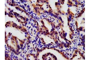 IHC image of ABIN7173883 diluted at 1:180 and staining in paraffin-embedded human lung cancer performed on a Leica BondTM system.