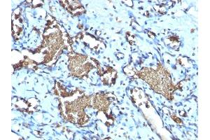 Formalin-fixed, paraffin-embedded human Angiosarcoma stained with Glycophorin A Rabbit Recombinant Monoclonal Antibody (GYPA/1725R). (Recombinant CD235a/GYPA anticorps)