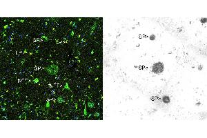 Immunohistochemical analysis of paraffin-embedded Alzheimer's hippocampus using Thioflavin S (left panel) and Beta Amyloid antibody using the HRP-DAB staining technique.