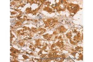 Immunohistochemistry of Human breast cancer using CPB1 Polyclonal Antibody at dilution of 1:50 (CPB1 anticorps)