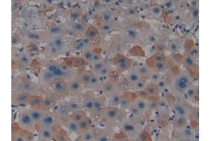Detection of PADI4 in Human Liver cancer Tissue using Polyclonal Antibody to Peptidyl Arginine Deiminase Type IV (PADI4) (PAD4 anticorps  (AA 1-300))