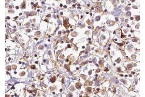 ABIN6277670 at 1/100 staining Human breast cancer tissue by IHC-P. (CTNNA1 anticorps  (Internal Region))