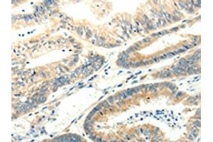The image on the left is immunohistochemistry of paraffin-embedded Human colon cancer tissue using ABIN7131272(SYT5 Antibody) at dilution 1/15, on the right is treated with fusion protein.