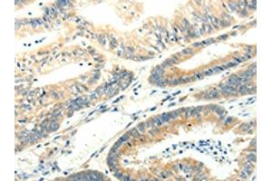 The image on the left is immunohistochemistry of paraffin-embedded Human colon cancer tissue using ABIN7131272(SYT5 Antibody) at dilution 1/15, on the right is treated with fusion protein. (Synaptotagmin V anticorps)