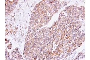 IHC-P Image Immunohistochemical analysis of paraffin-embedded human endometrial cancer, using cGK1, antibody at 1:500 dilution. (PRKG1 anticorps  (Center))