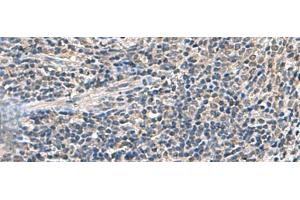 Immunohistochemistry of paraffin-embedded Human cervical cancer tissue using ATP5F1D Polyclonal Antibody at dilution of 1:55(x200) (ATP5F1D anticorps)