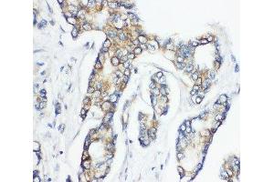 IHC-P: CD1d antibody testing of human breast cancer tissue