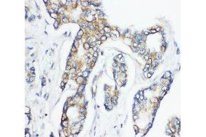 IHC-P: CD1d antibody testing of human breast cancer tissue (CD1d anticorps  (AA 76-92))
