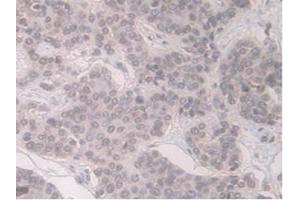DAB staining on IHC-P;Samples:Human Pancreas Cancer Tissue) (ORM1 anticorps  (AA 19-201))