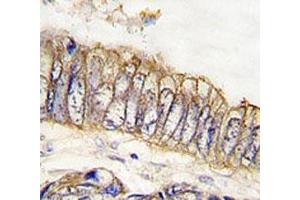 IHC analysis of FFPE human colon carcinoma tissue stained with MET antibody