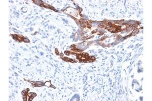 IHC staining of FFPE human gastric carcinoma with recombinant Gastric Mucin antibody (clone MUC6/1553R).