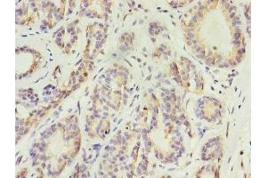 Immunohistochemistry of paraffin-embedded human breast cancer using ABIN7157372 at dilution of 1:100