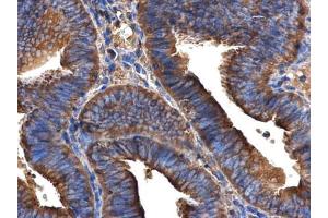 IHC-P Image ARFIP2 antibody [N1C2] detects ARFIP2 protein at cytoplasm in human endometrial cancer by immunohistochemical analysis. (ARFIP2 anticorps)