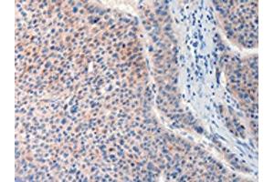The image on the left is immunohistochemistry of paraffin-embedded Human liver cancer tissue using ABIN7190632(FAT4 Antibody) at dilution 1/20, on the right is treated with synthetic peptide. (FAT4 anticorps)
