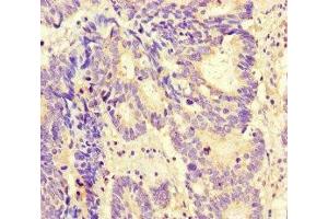 Immunohistochemistry of paraffin-embedded human colon cancer using ABIN7165797 at dilution of 1:100 (MAX anticorps  (AA 1-58))