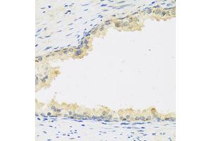 Immunohistochemistry of paraffin-embedded human prostate using LIF antibody (ABIN5974705) at dilution of 1/100 (40x lens). (LIF anticorps)