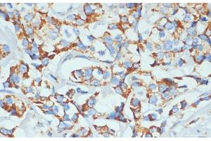 Immunohistochemistry of paraffin-embedded Human breast cancer using DDX3X Polyclonal Antibody at dilution of 1:100 (40x lens).