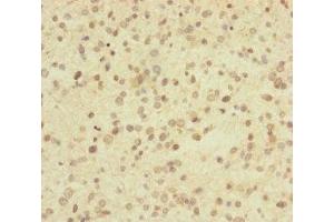 Immunohistochemistry of paraffin-embedded human glioma using ABIN7174279 at dilution of 1:100 (USP2 anticorps  (C-Term))