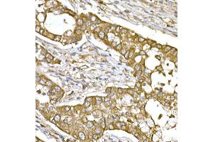 Immunohistochemistry of paraffin-embedded human lung cancer using β-Tubulin Rabbit pAb (ABIN3020552, ABIN3020553 and ABIN3020554) at dilution of 1:250 (40x lens). (TUBB anticorps  (AA 40-260))