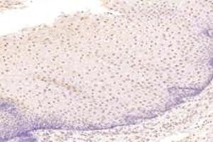 Immunohistochemistry analysis of paraffin-embedded human esophageal cancer using TBX10 (ABIN7075814) at dilution of 1: 4600 (T-Box 10 anticorps)
